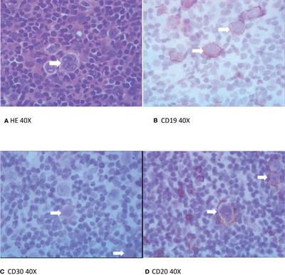 CD19 and <mark class="highlighted">CD30</mark> CAR T-Cell Immunotherapy for High-Risk Classical Hodgkin’s Lymphoma
